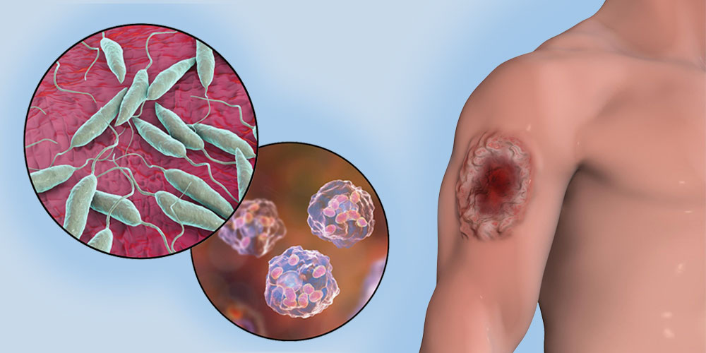 cutaneous leishmaniasis research 1